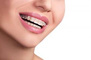 ceramic braces singapore