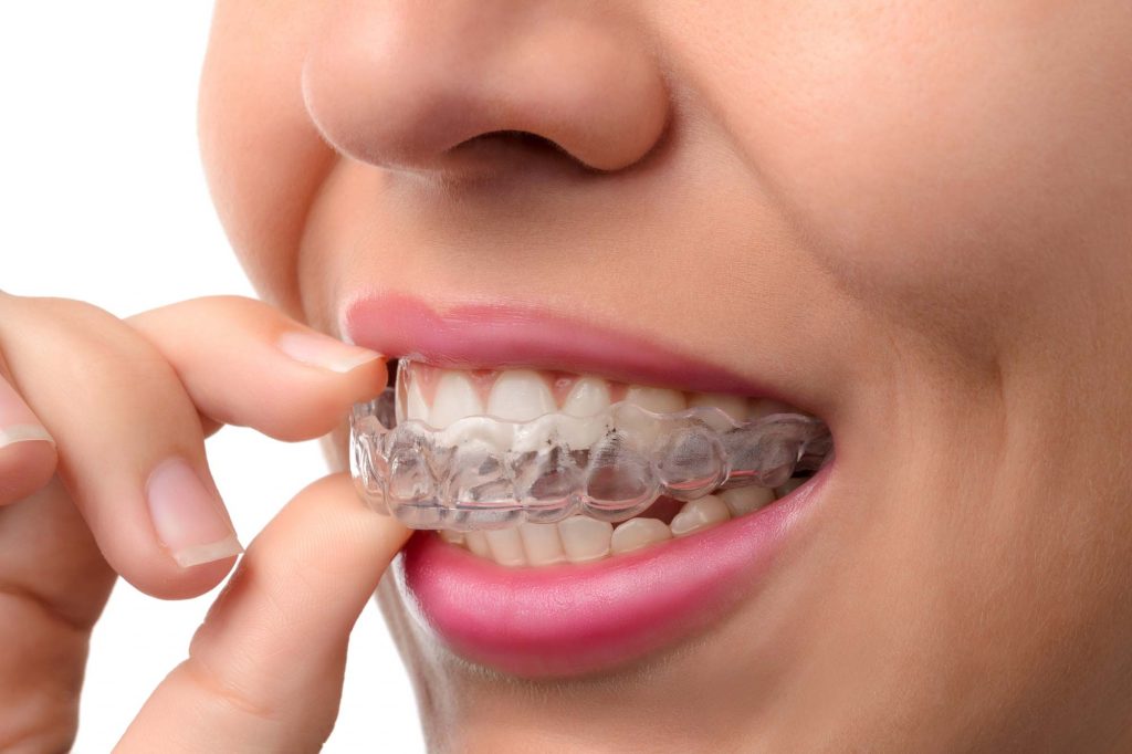 clear aligners braces singapore