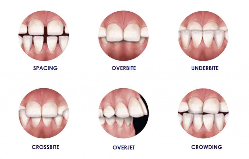 orthodontic problems that we fix with our braces, singapore