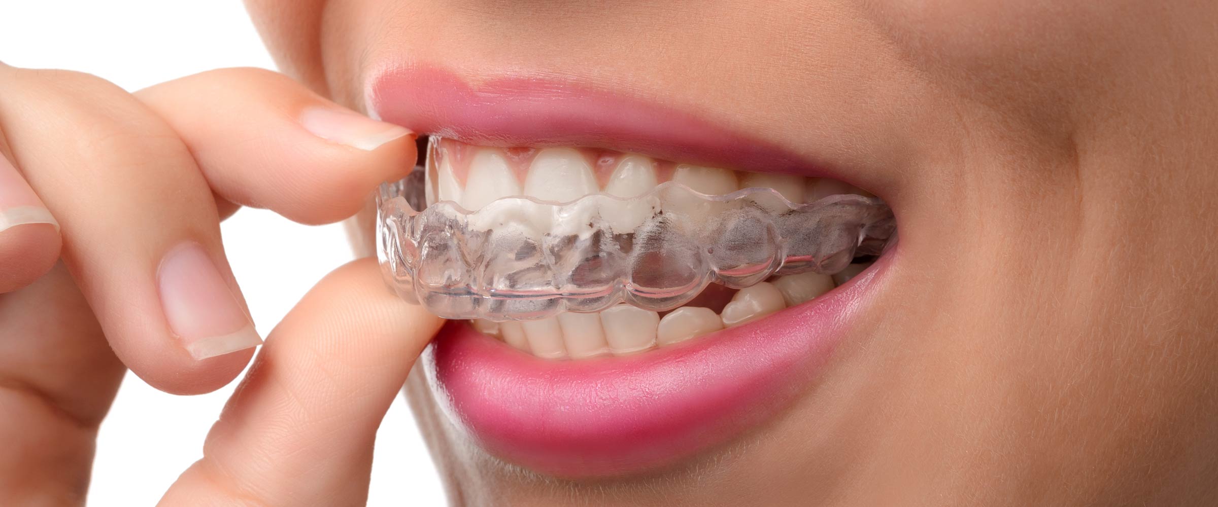 Various kinds of dental braces and their purpose - Family Dental
