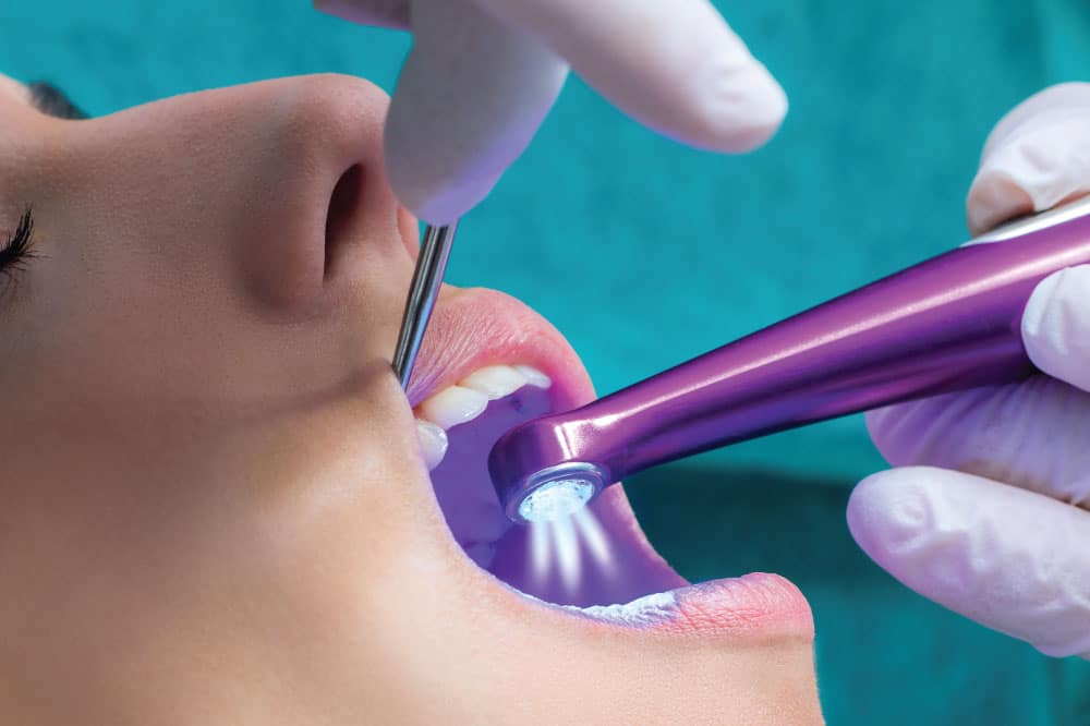 fissure sealants