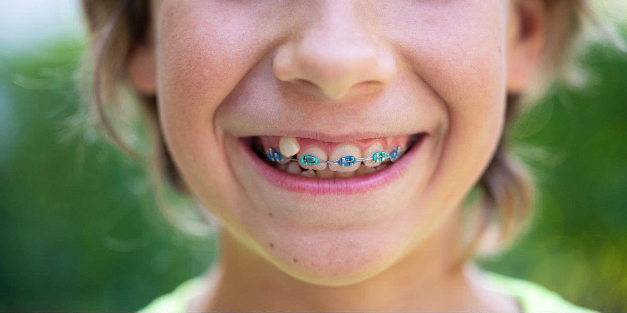 Finding The Right Dental Clinic In Sg For Childrens Braces