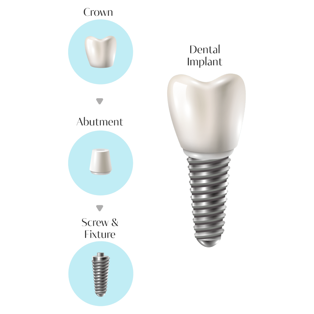 dental_implant_1080x1080