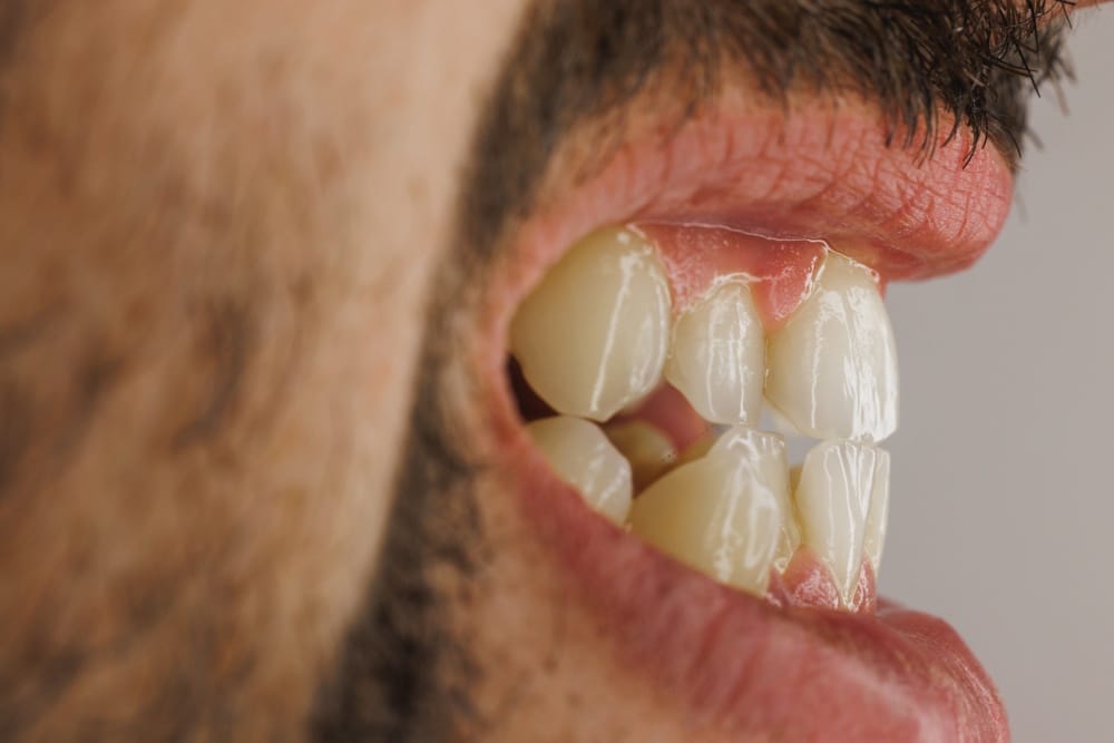 close-up side view of a man’s teeth