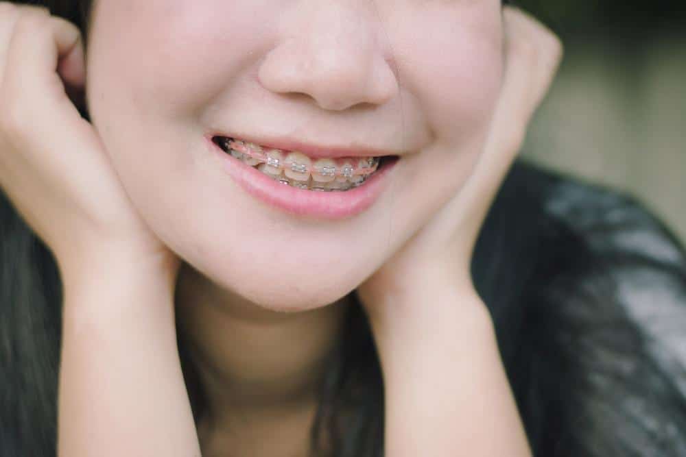 a lady smiling with pink metal braces