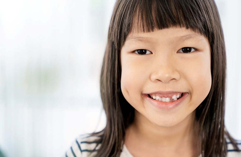 Child smiling with visible dental misalignment