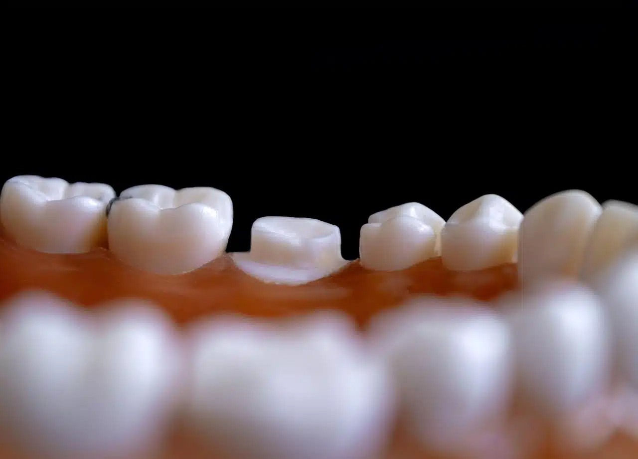 A gap between teeth can be cosmetic or indicates an underlying condition.