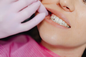 Common Teeth Alignment Issues: Causes and Treatment