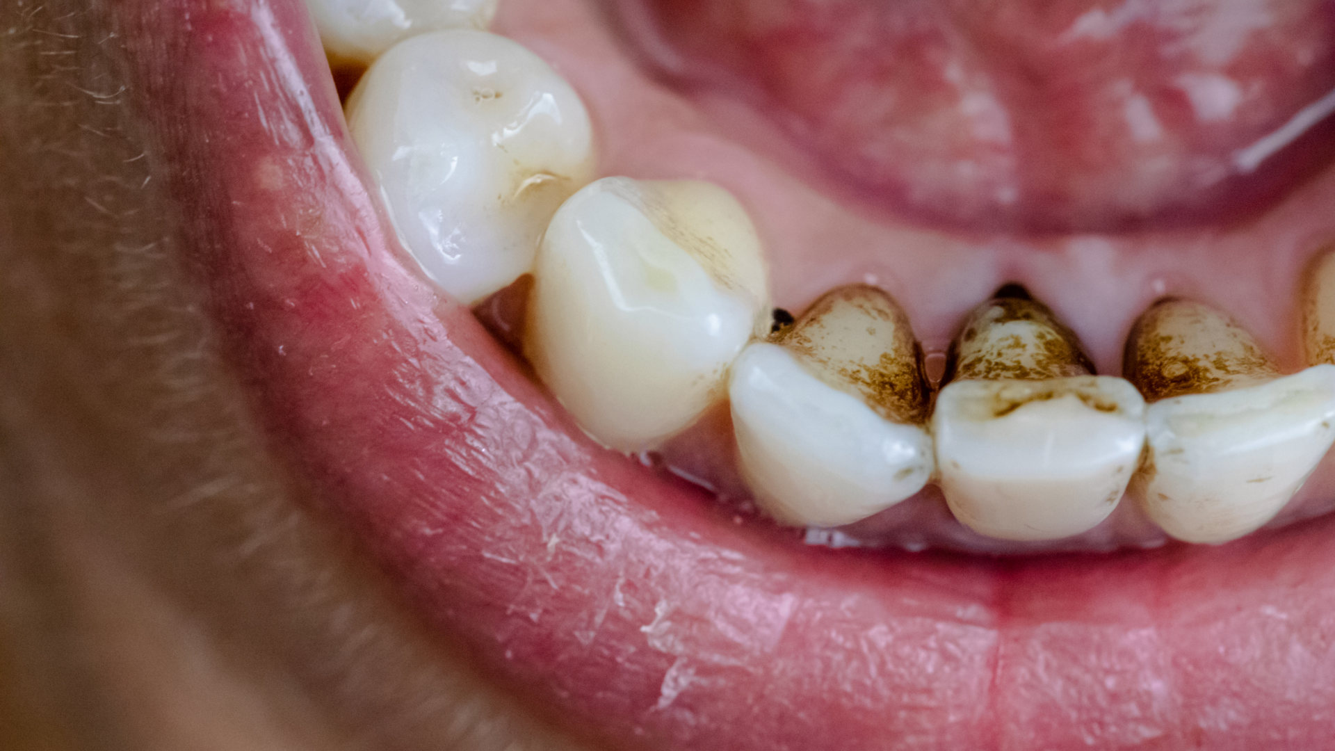 How to Reduce Teeth Staining from Coffee, Tea, and Wine