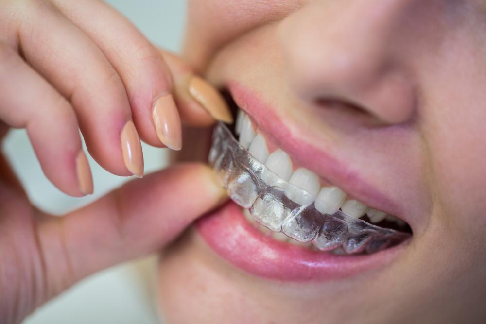 a young lady putting on clear aligners